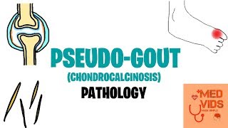 PSEUDOGOUT PATHOLOGY  MED VIDS MADE SIMPLE [upl. by Saxe495]