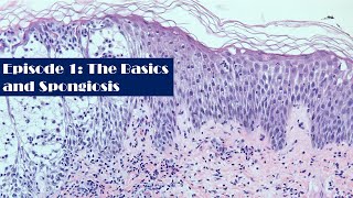 Episode1 A Survey of Dermatopathology The Basics and Spongiosis [upl. by Sennahoj869]