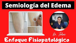 Semiología del EDEMA  Enfoque Fisiopatológico [upl. by Siuqram]