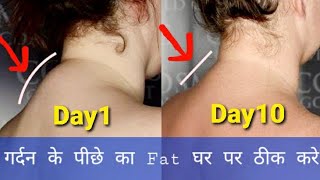 How to fix neck hump at home  neck hump exercises  remove fatty neck hump  fix neck hump [upl. by Olegnad]