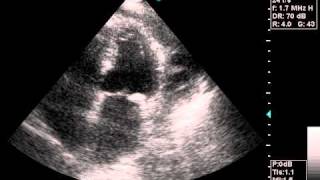 echocardiography pericardial effusionavi [upl. by Atnohs748]