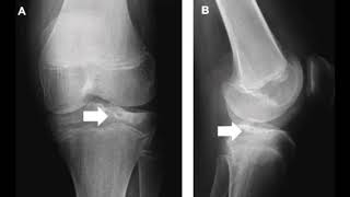 OSTEOCONDRITIS DISECANTE CAUSAS SÍNTOMAS Y TRATAMIENTO DATOS CLÍNICOS [upl. by Assetan]