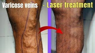 Combination treatment of varicose veins  Laser  Foam Sclerotherapy Laser treatment of varicose [upl. by Atnuahsal85]