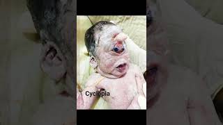 Cyclopia Cyclocephaly Synophthalmia   Rare form of holoprosencephaly amp its congenital disorder [upl. by Attenaej104]