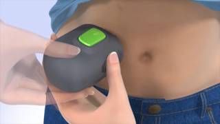 Medtronic  How to insert the Guardian Connect CGM [upl. by Eelatsyrc]