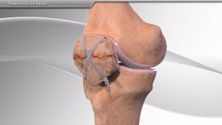 Patella Fracture Repair [upl. by Icken159]