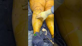 Liposuction for lipedema legs  IMMEDIATE RESULTS lipedema [upl. by Aennyl]