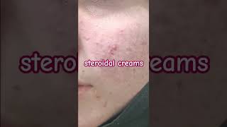 Whitening Cream Side Effects l Red Face [upl. by Luy]