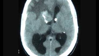 Frontal Intraventricular tumor with hydrocephalus [upl. by Soinski]