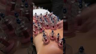 The Cupping Therapy an Ancient Treatment  InFact Tamil shortsvideo [upl. by Philipp]