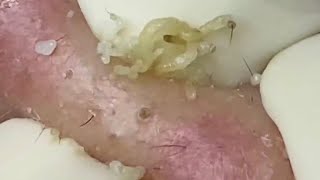 Big blackheads removal  pimple popping  Nhat Bang Acne Treatment  Chuyen Nguyen Spa 7 [upl. by Seuqirdor]