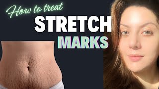 How to Remove Stretch Marks after Pregnancy I How to Remove Stretch Marks at Home [upl. by Ylelhsa891]