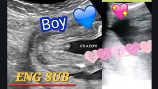 How to tell gender of Twins on ultrasound Twins Gender reveal near me  Twins heartbeat ❤️ scan [upl. by Trudie189]