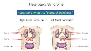 Fetal Echo Understanding Cardiovascular Abnormalities in Heterotaxy Syndrome [upl. by Okimuk]