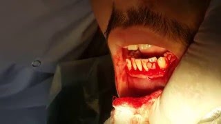 Gingivectomy  Dr Muhammed I Hazeem [upl. by Martyn]