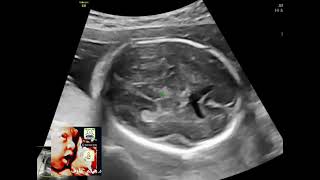 Colpocephaly absent CSP partial agenesis corpus callosum fetal ultrasound by DrHaissam Aref DMS [upl. by Johannes228]