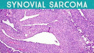 Synovial Sarcoma explained in 5 minutes Soft Tissue Pathology Basics [upl. by Akeim]