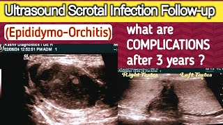 Chronic Scrotal Infection  Complications  Male Infertility  Epididymo Orchitis [upl. by Eessej]