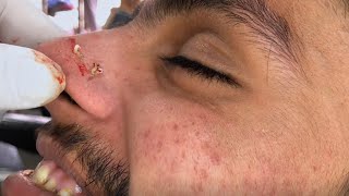 Blackheads on Nose poppingblackheads [upl. by Erreipnaej535]