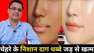 चेहरे के Dark Spots और Hyperpigmentation Melasma से छुटकारा पाएं  facial like glow in 10 minutes [upl. by Akemal]