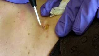 Dorset Somerset Bristol and Southwest England Mole Removal Surgery  cosmetic radiosurgery [upl. by Charo]