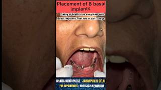 Now fixing new teeth is possible in just 7 days with basal implants basalimplants [upl. by Notaes]