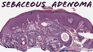 Sebaceous Adenoma 5Minute Pathology Pearls [upl. by Lhadnek]