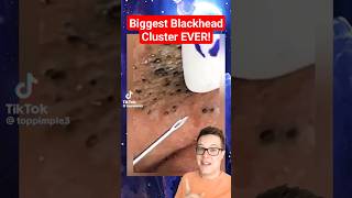 BIGGEST BLACKHEADS REMOVAL EVER  Extreme Blackheads on Cheek shorts [upl. by Mitchiner15]