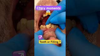 Crazy Teeth  Broken Fillings [upl. by Arakahs]