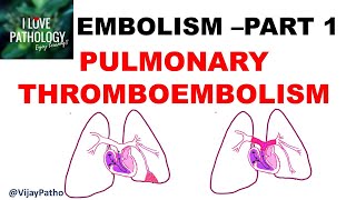 EMBOLISM Part 1 Pulmonary amp Systemic thromboembolism [upl. by Leipzig]