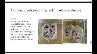 GROSS PATHOLOGY OF CHRONIC PYELONEPHRITIS [upl. by Fanechka]