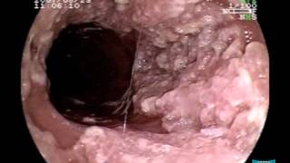 Endoscopic Imaging of Esophageal Verrucous Carcinoma [upl. by Ailemap]