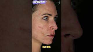 Acne Scar Treatment [upl. by Berkley]