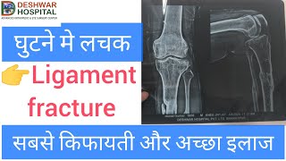 घुटने मे लचक का इलाज PCL LIGAMENT FRACTURE TREATMENT acl pcl aclsurgeon ytshorts [upl. by Netsyrc851]