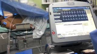 AICD defibrillation threshold test [upl. by Sakhuja]