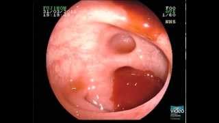 Diverticular Bleeding [upl. by Miculek984]