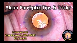 Alcon PanOptix Trifocal IOL Tips amp Tricks for Cataract Surgery [upl. by Martie]