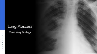 Lung Abscess Explanation of Chest Xray Findings [upl. by Ynatsed]