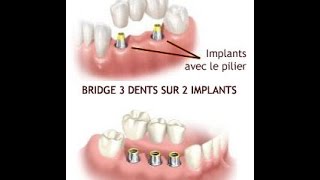 MES IMPLANTS DENTAIRES  PRIX [upl. by Ahsatniuq]