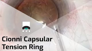 Cionni CTR  Capsular Tension Ring  Presentation  FCI Cataract [upl. by Barolet]