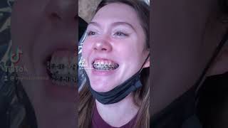 What happens when you get your braces off [upl. by Persons]