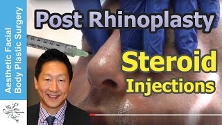 Live Demo Post Rhinoplasty Steroid Kenalog Injections for Swelling Healing by Seattle DrYoung [upl. by Essiralc]