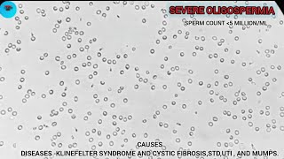 Severe oligospermia under microscope causes and risk factors [upl. by Kynthia350]