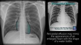 Radiograph Tutorial Chest Xray  CXR  Radiology Nation [upl. by Tol780]