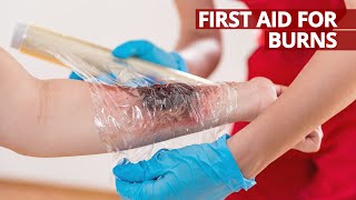 What to do and how to give First Aid for Burns FirstAid BeALifesaver [upl. by Bigelow]