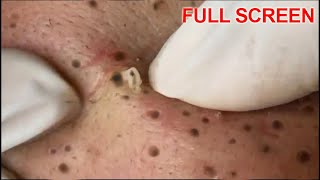 Blackheads Removal  Best Pimple Popping Videos [upl. by Fergus655]