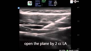 ultrasound guided subcostal TAP block [upl. by Ahsert]