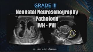 Neonatal Neurosonography  Pathology  IVH  PVL [upl. by Austina]