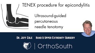 TENEX Procedure for Epicondylitis tennis and golfers elbowDr Jeff ColeOrthoSouth [upl. by Lennon408]