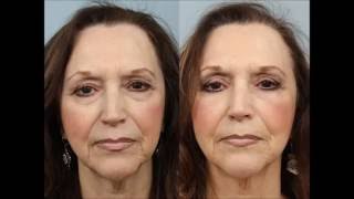 Female Blepharoplasty Before and After by Dr Edwin Williams [upl. by Plume]